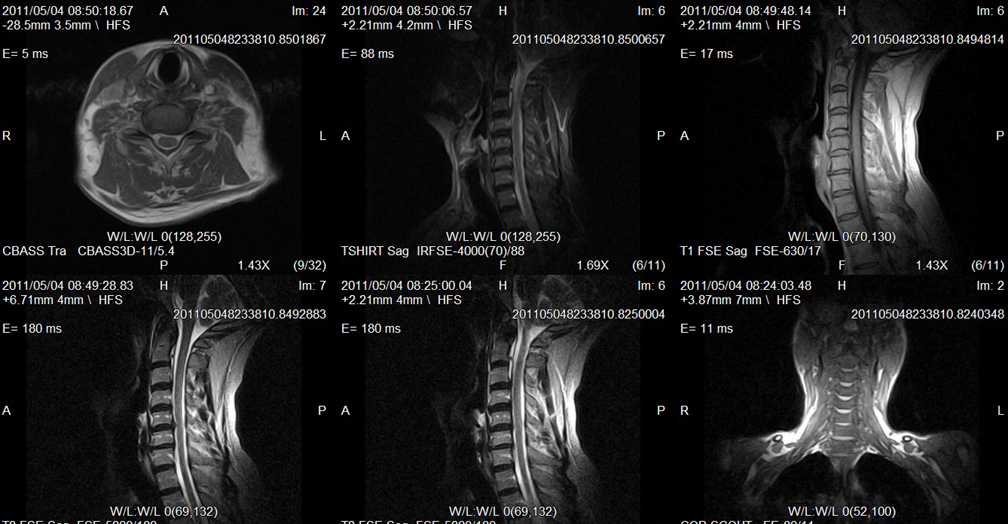 spine