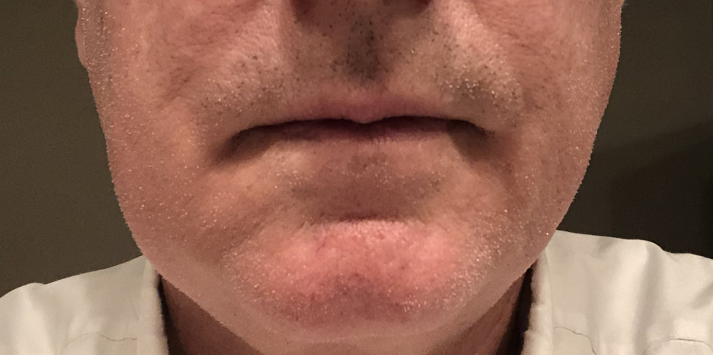 lumpy