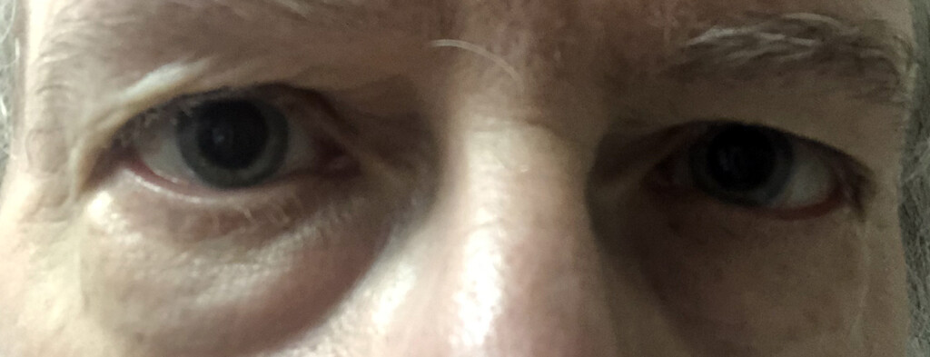dilated